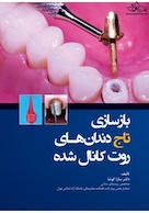 بازسازی تاج دندان های روت کانال شده